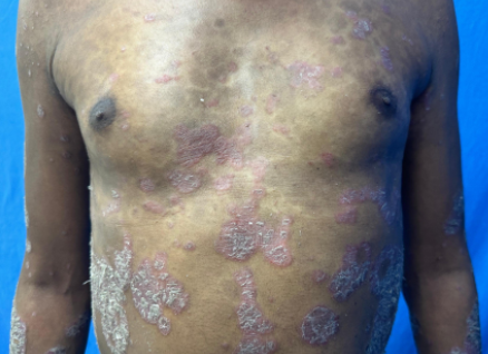 Psoriasis